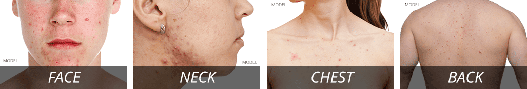 Choosing an acne treatment