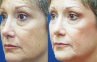 fine-lines-and-wrinkles-mixto-laser-2