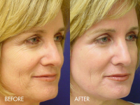 fine-lines-and-wrinkles-mixto-laser-3