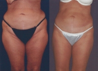 liposuction-lipo-thighs-02