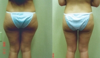 liposuction-lipo-thighs-3