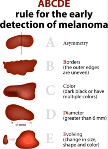 ABCDEs of Melanoma
