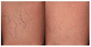 Causes and Treatment of Spider Veins